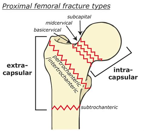 Femoral Neck Fractures .